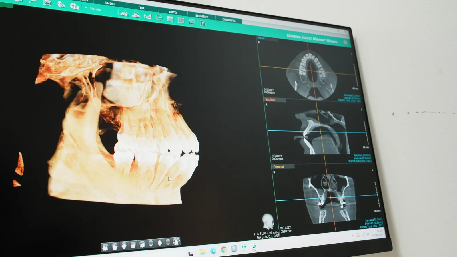 Reconstrucción TAC 3D para planificación de implantes